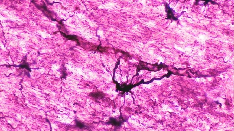 Two People With Severe Autoimmune Disease in Remission After Immune 'Reset'